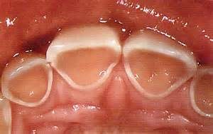 前歯の酸蝕
